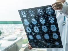 ASTUCE Spain pide garantizar acceso a tratamientos para el oligodendroglioma