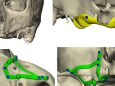 La innovación tecnológica revoluciona la rehabilitación dental en pacientes con pérdida ósea extrema