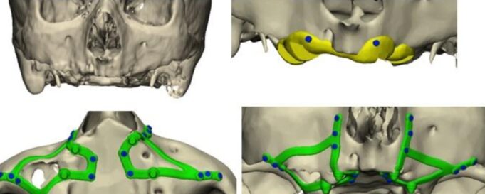 La innovación tecnológica revoluciona la rehabilitación dental en pacientes con pérdida ósea extrema
