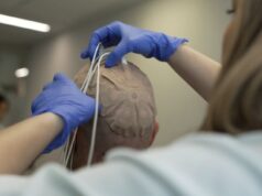 Hospital público 12 de Octubre investiga TTFields y pembrolizumab en ensayo clínico para glioblastoma recién diagnosticado