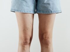 Varices y mala circulación: por qué no debemos normalizar las piernas hinchadas