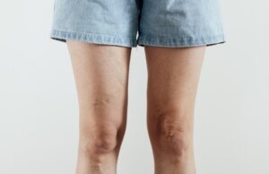 Varices y mala circulación: por qué no debemos normalizar las piernas hinchadas
