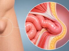 Los especialistas de Olympia Quirónsalud explican cuándo una hernia puede operarse sin ingreso