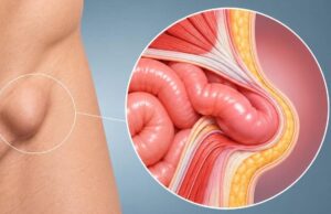 Los especialistas de Olympia Quirónsalud explican cuándo una hernia puede operarse sin ingreso